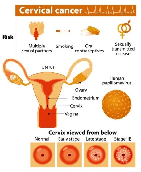 Cervical Cancer