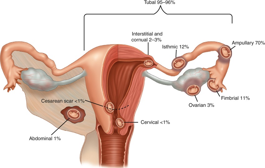 Ectopic Pregnancy