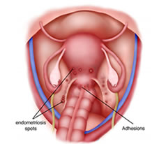 Endometriosis