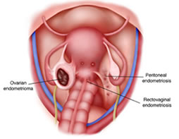 Endometriosis