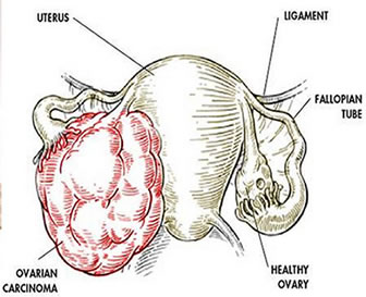 Ovarian Cancer