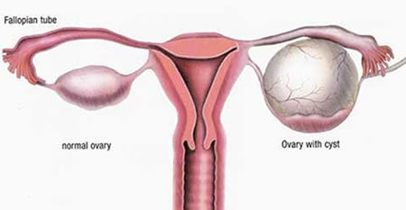 Ovarian Cysts